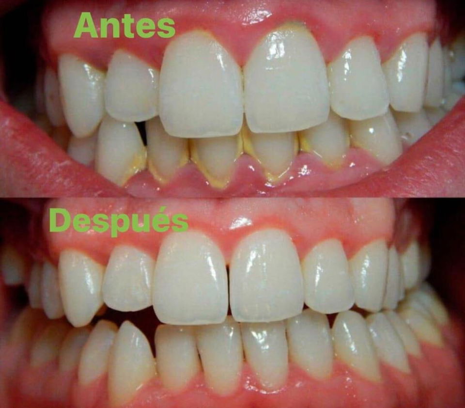 Portada de Limpieza dental profesional en La Habana, Plaza