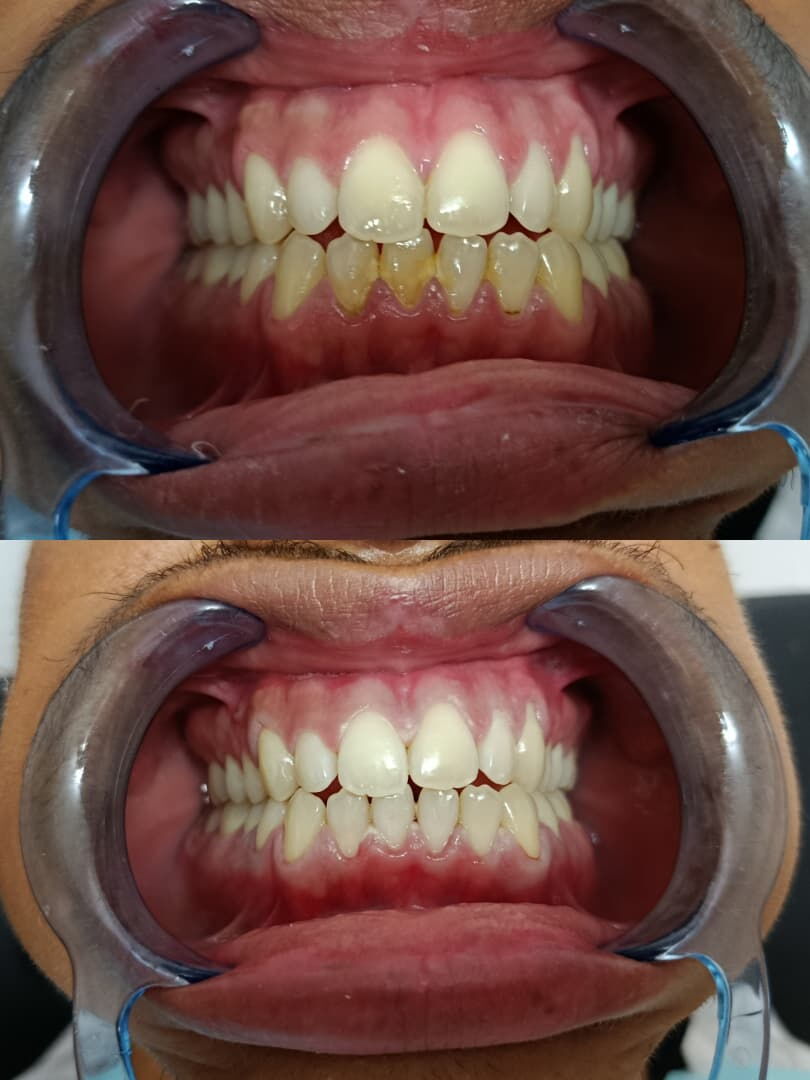Portada de Blanqueamiento Dental en Centro Habana