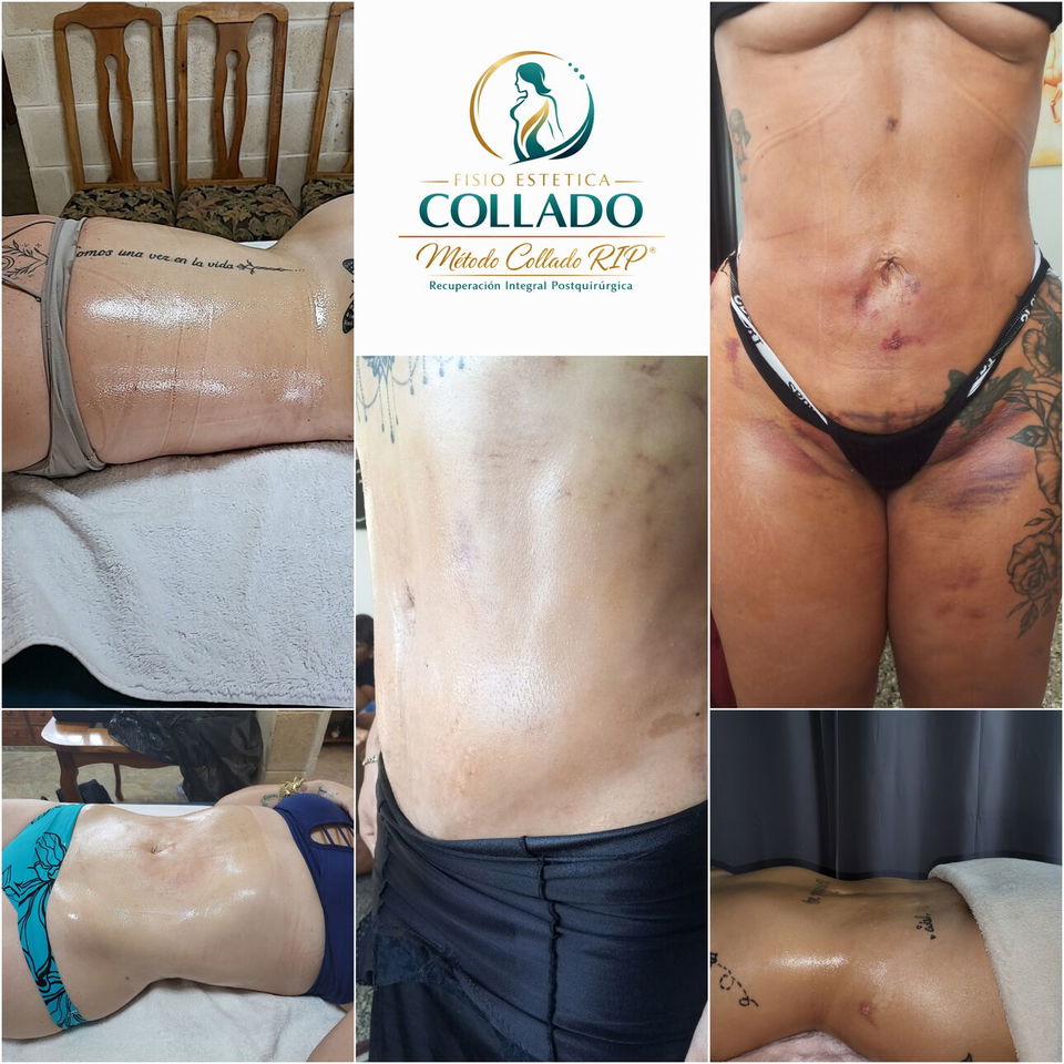 Portada de Drenaje linfático post quirúrgico, masajes post operatorio y aparatología a domicilio