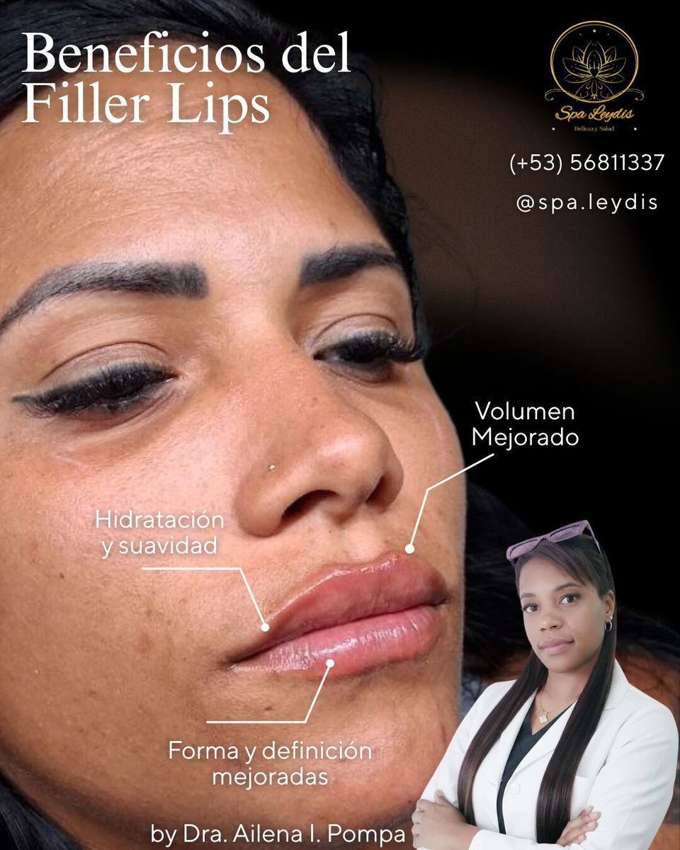 Portada de Aumento de labios con ácido hialurónico – 20% descuento por el Día de las Madres y los Padres