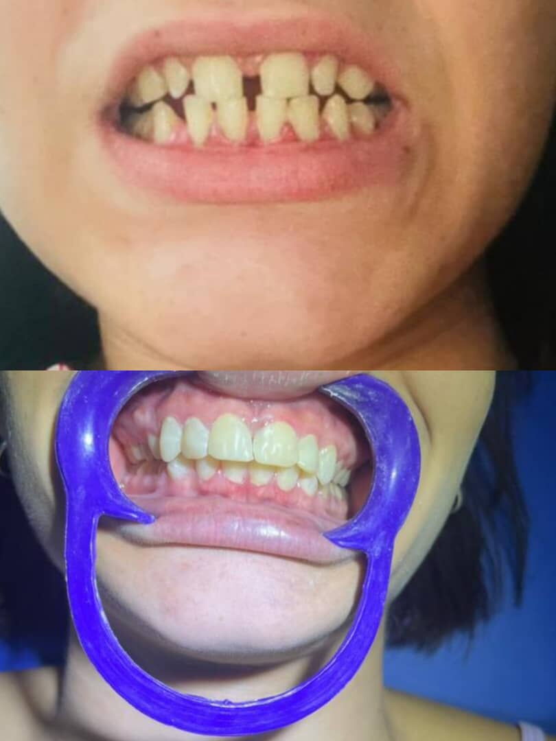 Portada de Diseño de sonrisa: 16 piezas superiores e inferiores