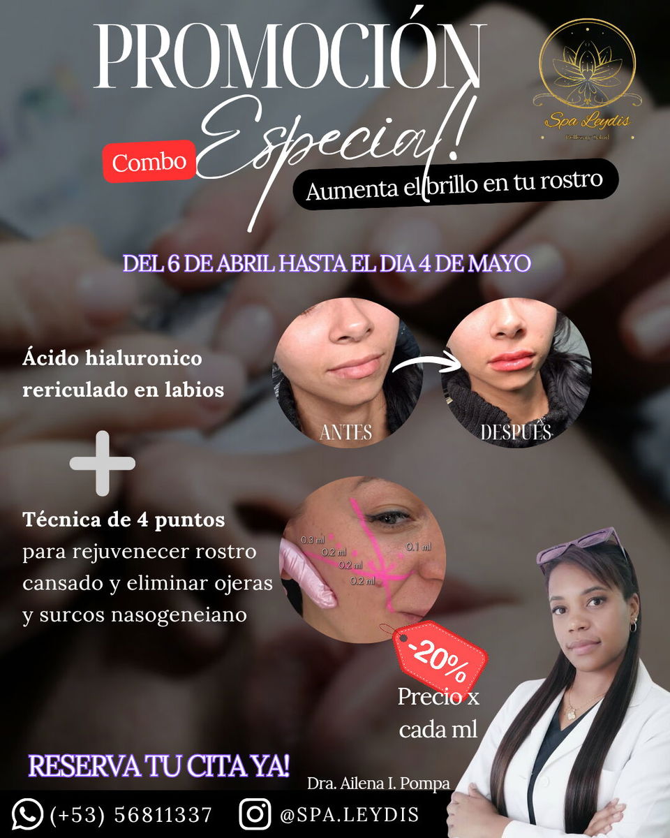 Portada de Aumento de labios con ácido hialurónico y técnica de 4 puntos en Marianao
