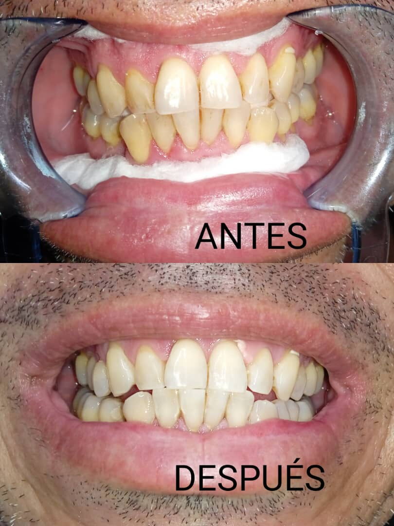 Portada de Blanqueamiento dental profesional con descuento