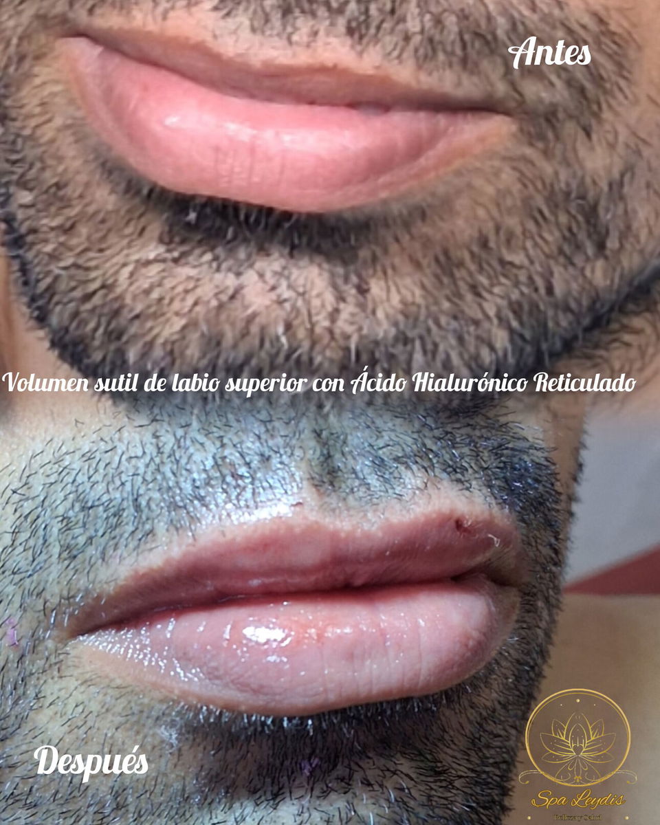 Portada de Aumento de labios con ácido hialurónico en Marianao