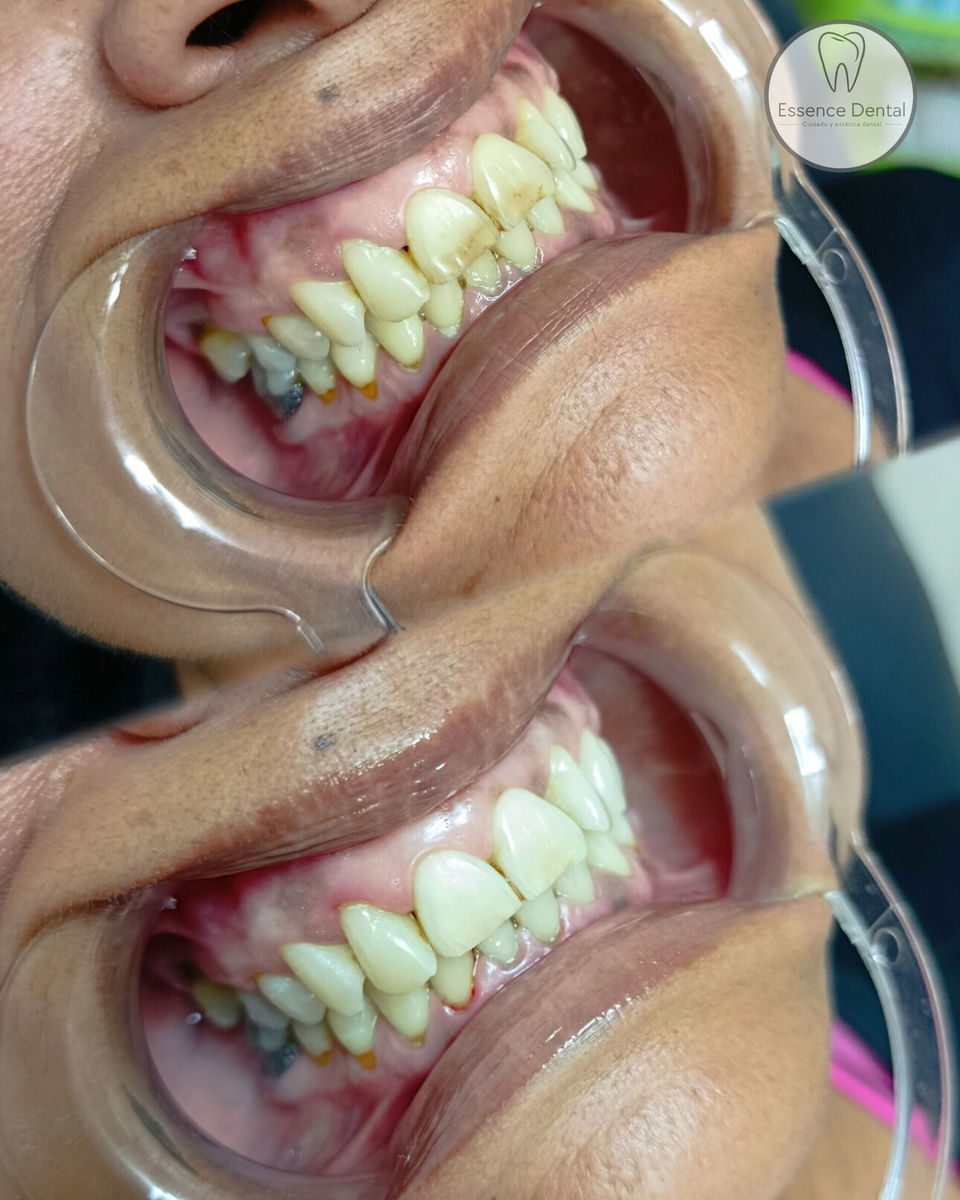 Portada de Blanqueamientos dentales en Centro Habana